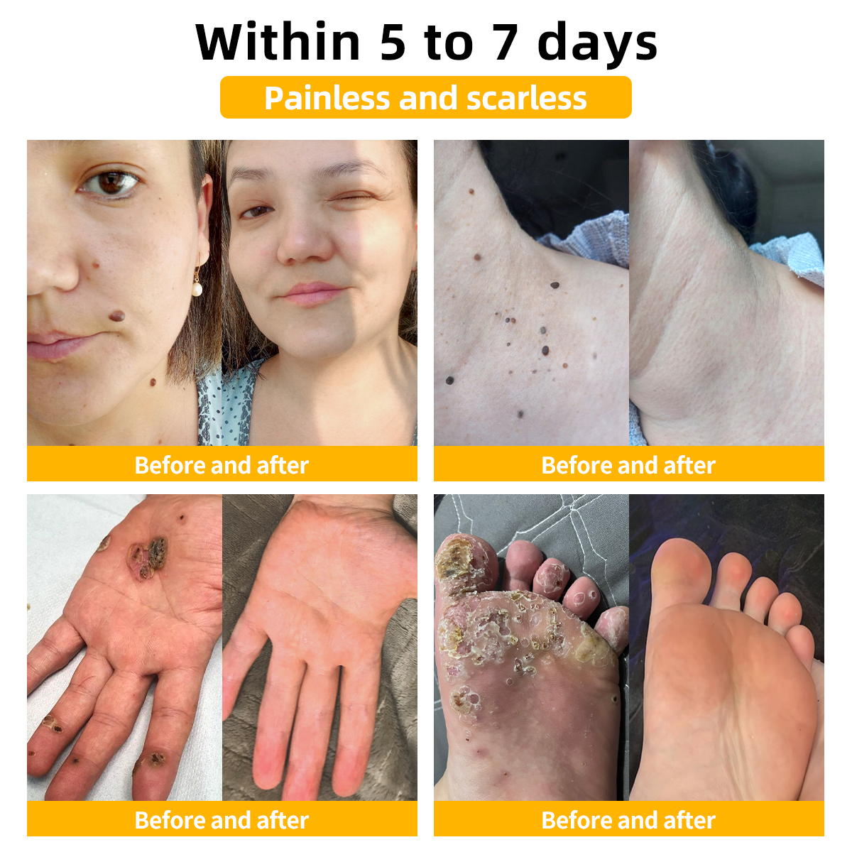 🌿🌿𝐏𝐢𝐠𝐮𝐢𝐚𝐲™ Bee Venom Wart & Tag Removal Cream(👨‍⚕Suitable for all skin types)🐝(🔥Last day promotion 60% off)