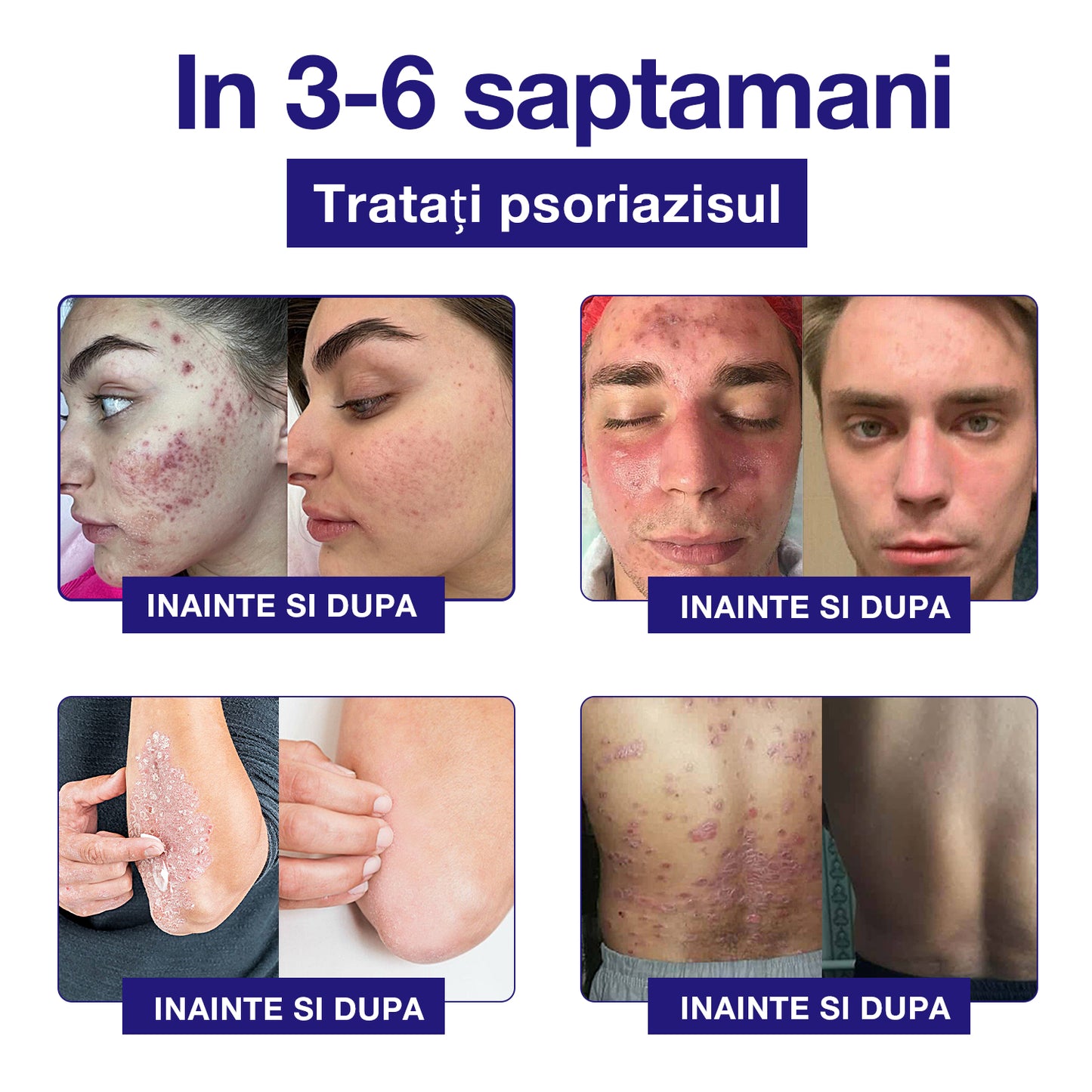 🐝🐝 Piguay ™  Cremă antibacteriană cu venin de albine (potrivită pentru toate tipurile de piele)