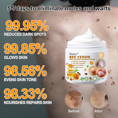 🌿🌿𝐏𝐢𝐠𝐮𝐢𝐚𝐲™ Bee Venom Wart & Tag Removal Cream(👨‍⚕Suitable for all skin types)🐝(🔥Last day promotion 60% off)